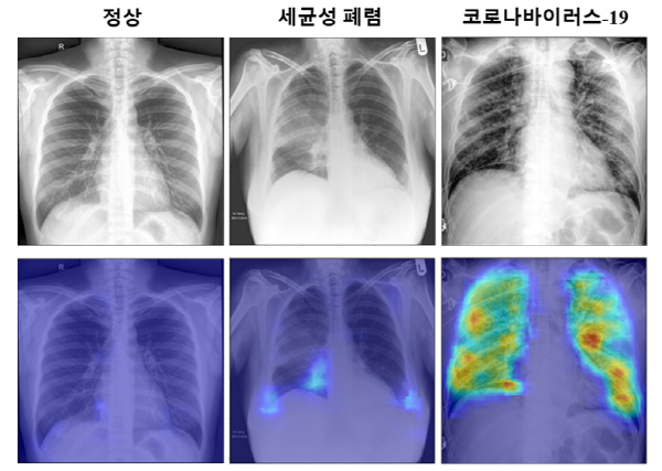 ▲ KAIST, 코로나19 영상 AI 진단 기술 개발 (사진=로봇신문)