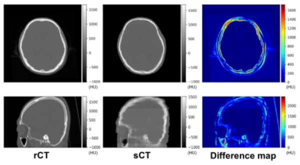 사진 1 왼쪽 첫 번째(rCT)는 일반 CT 사진, 가운데(sCT)는 MRI에서 CT 정보를 유추한 사진이다. 맨 오른쪽 사진(Difference map)에서 rCT와 sCT의 차이를 의미하는 붉은 색이 거의 없는 것을 확인할 수 있다. (사진=연세의료원)