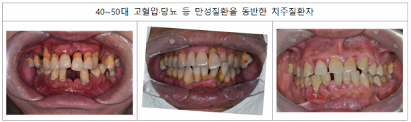 고혈압과 당뇨 등 만성질환을 동반한 40~50대 치주질환자(사진=국민건강보험공단)