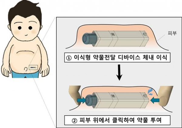 단 한 번의 이식 후 피부 위에서 손가락으로 클릭하면 정교한 양의 약물이 방출되는 디바이스(이미지=서울대병원)
