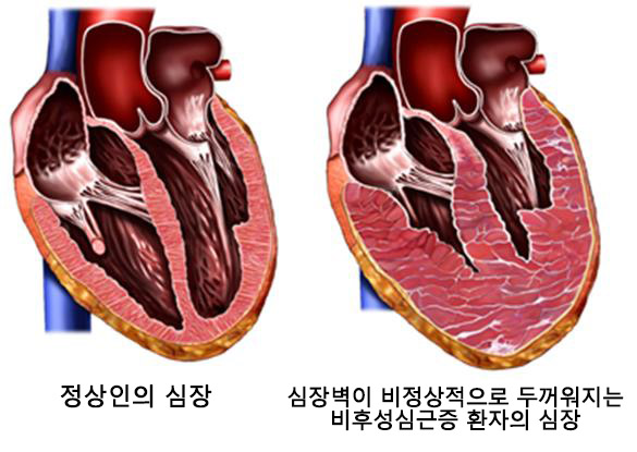 비후성심근증 모식도.(사진=서울대병원)