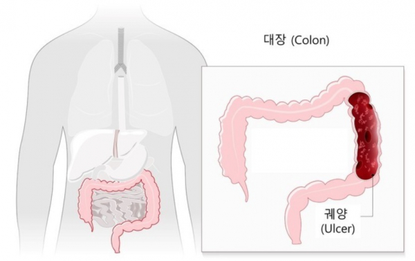 궤양성 대장염 이미지.(사진=서울대병원)