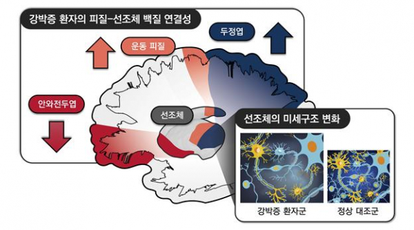 강박증 환자에서 관찰한 대뇌 피질-선조체 회로의 변화. 안와전두엽과의 연결성은 감소한 반면, 운동 피질과 두정엽과의 연결성은 증가해 있어, 대뇌피질-선조체 회로의 균형이 깨져있는 것으로 나타났다. 또한 연구팀은 강박증 환자에서 선조체 영역의 미세구조도 손상되었다는 것을 확인했다.(이미지=서울대병원)