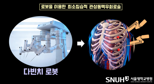 다빈치 로봇 활용 관상동맥우회로술(사진=서울대병원)