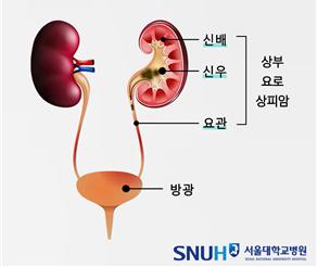 상부요로상피암(사진=서울대병원)