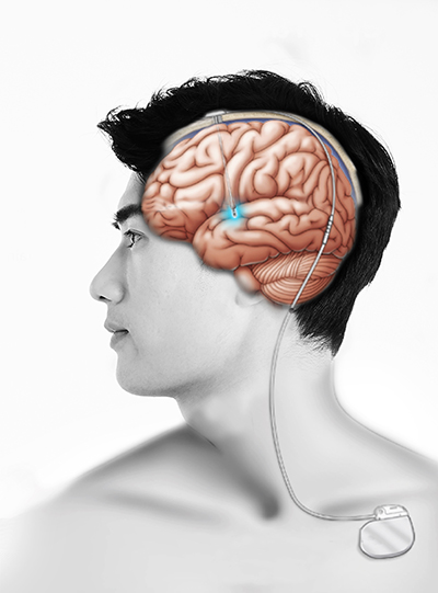 뇌심부자극술로 자극용 전극 삽입한 모식도.(그림=서울대병원)